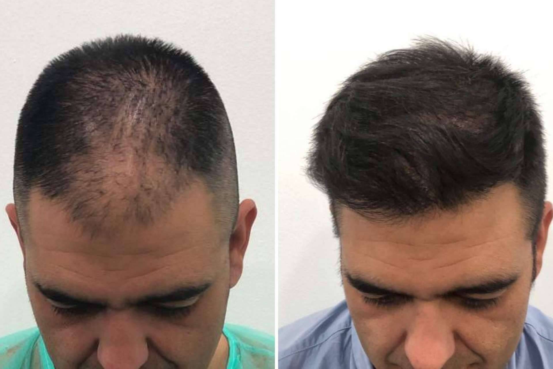 La exclusiva técnica META FUE 3 Dual para el injerto capilar en Injermur, ¿cuáles son sus ventajas y cómo funciona?