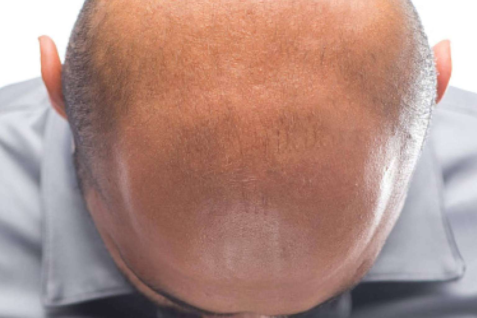 ¿Cuáles son los beneficios de la micropigmentación capilar?, por Dermopigmentación Clínica