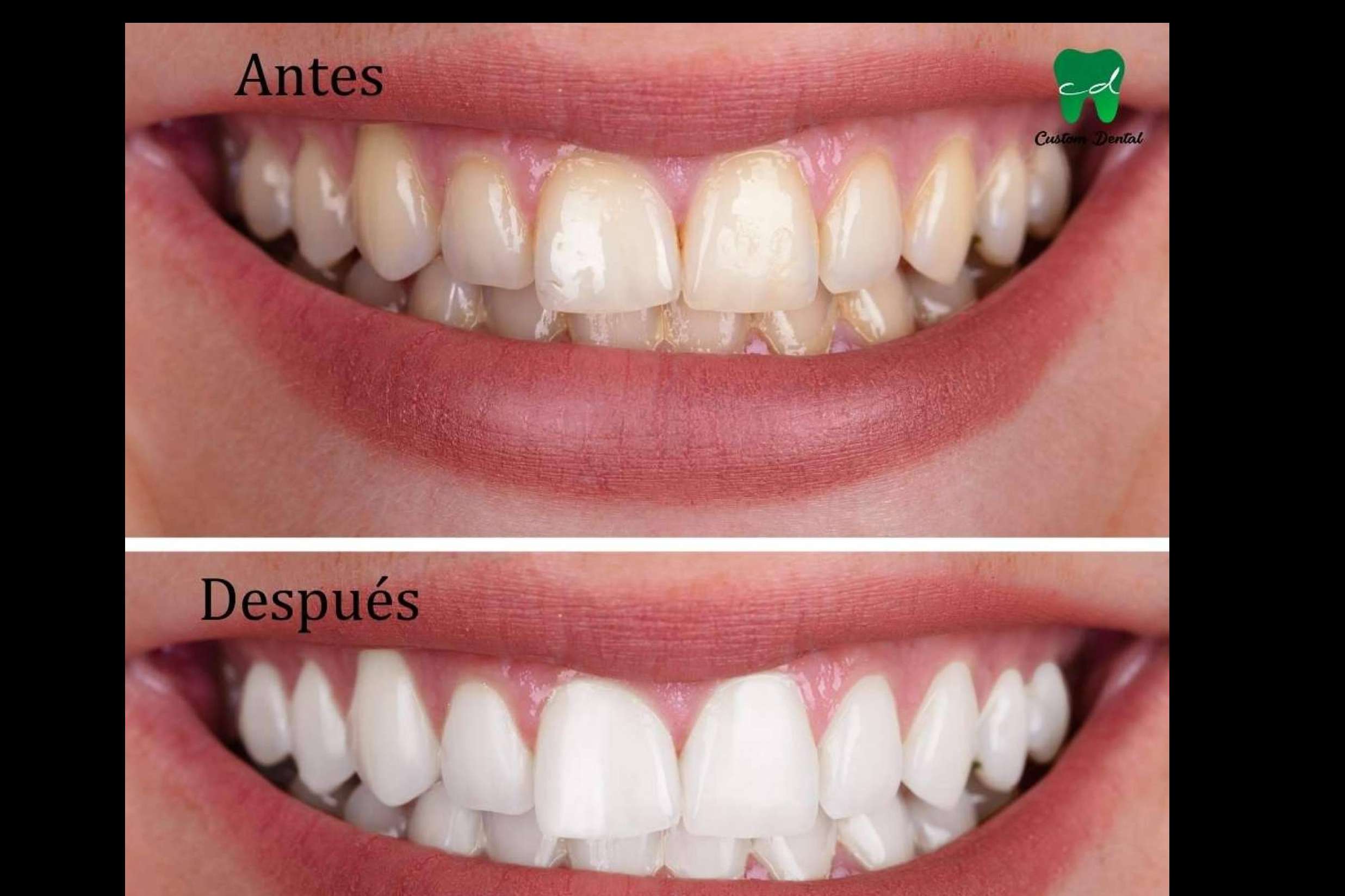 La importancia de una sonrisa radiante; Blanqueamiento dental en dos citas