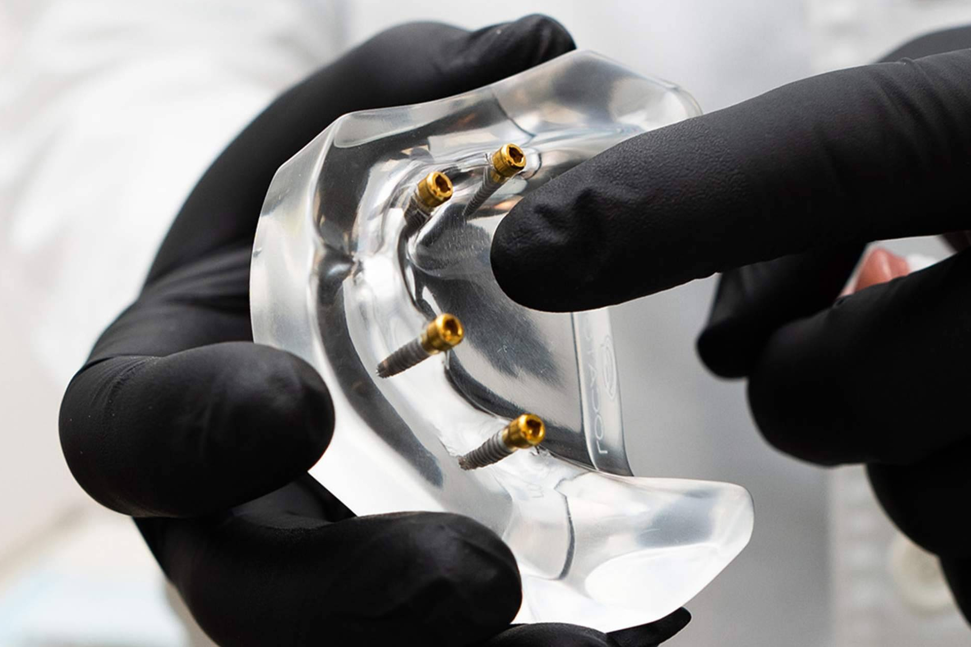 Implantes dentales personalizados y mínimamente invasivos en una clínica premium en Madrid