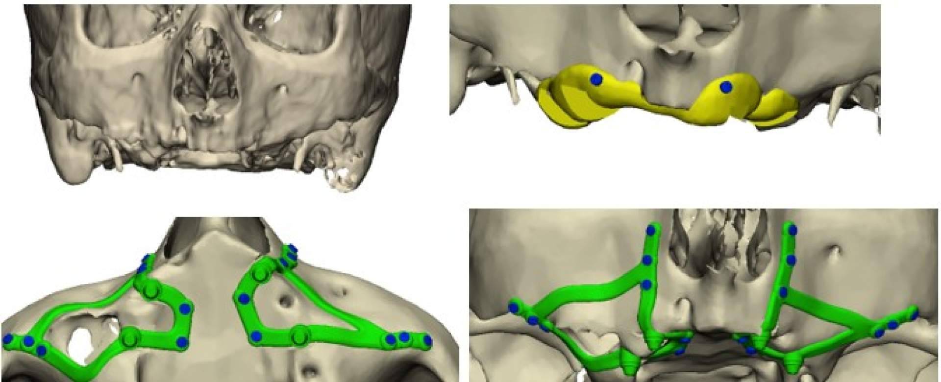Implantes subperiósticos; la tecnología 3D abre nuevas vías para la rehabilitación dental en maxilares severamente atróficos